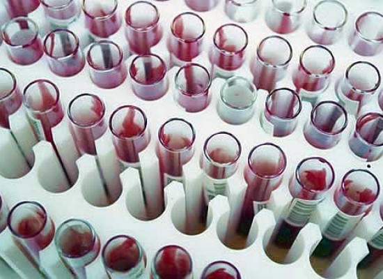 Kompletna laboratorijska analizu krvi i urina !