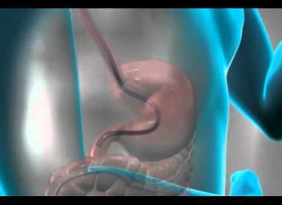 Gastroskopski pregled-pregled gornjih delova sistema organa za varenje(jednjaka, želuca i početnog dela tankog creva)!