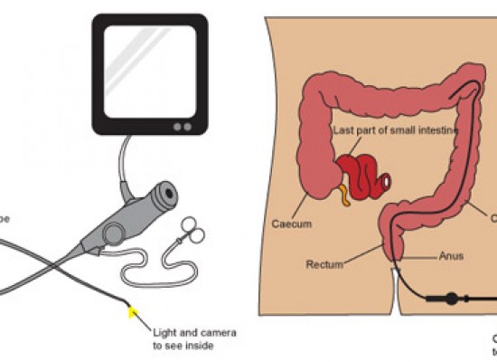 Pregled debelog creva kolonoskopijom u poliklinici na Vracaru! Pregled debelog creva kolonoskopijom u poliklinici na Vracaru!