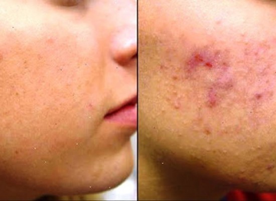 Mikrodermoabrazija dijamantskom sondom, specijalnim američkim aparatom u srcu Beograda!