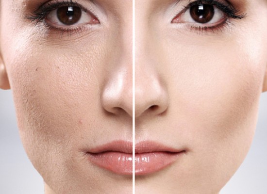 Mikrodermoabrazija dijamantskom sondom, specijalnim američkim aparatom u srcu Beograda!